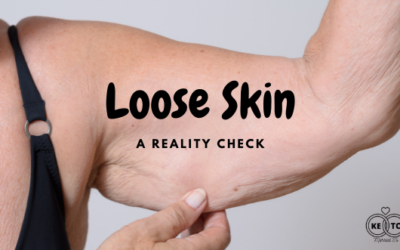 Loose Skin is a Reality in Weight Loss